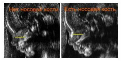 Отсутствие носовой кости на УЗИ
