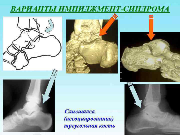 Задний импинджмент синдром голеностопного сустава мрт