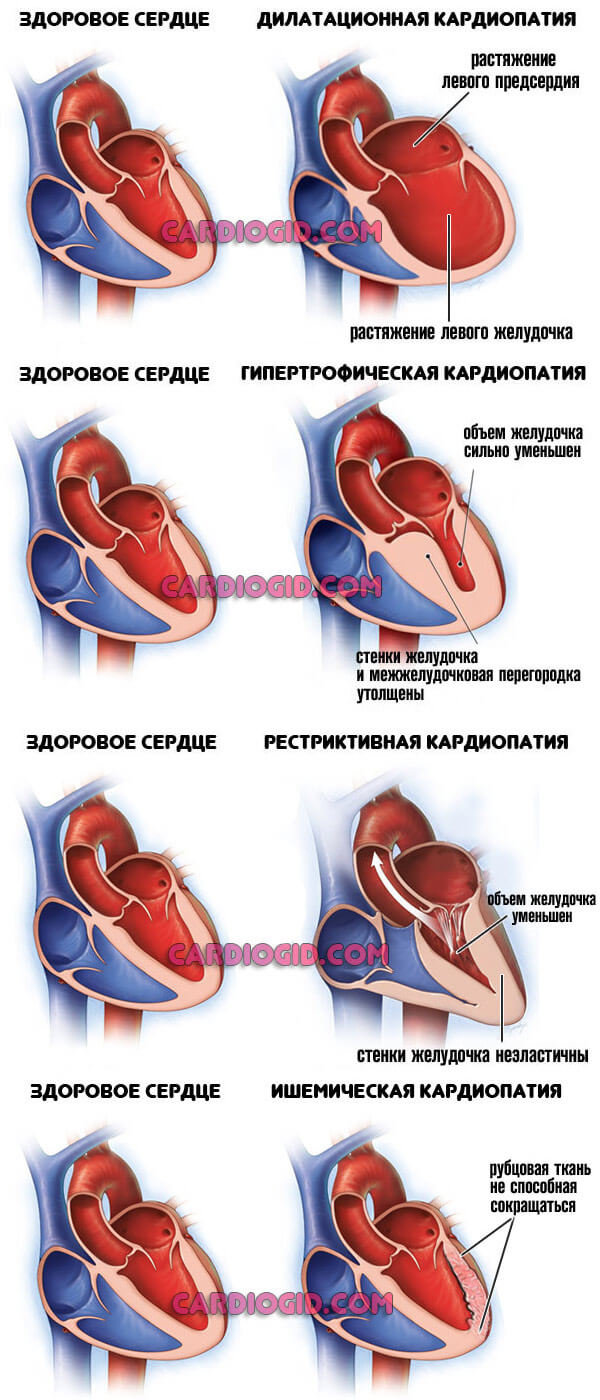 виды кардиомиопатии