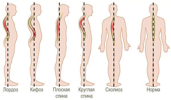 Виды нарушения осанки