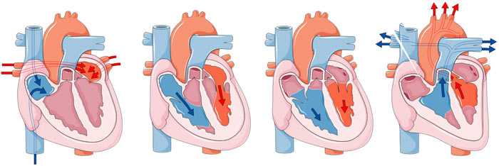 Wpw синдром и физическая нагрузка
