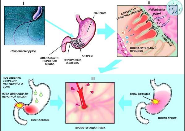 Патогенез язвенной болезни желудка